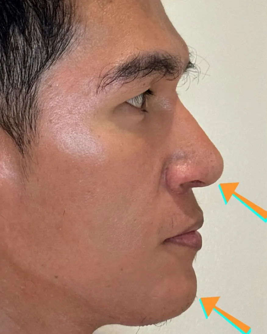 Rhinoplasty with Chin Augmentation, after