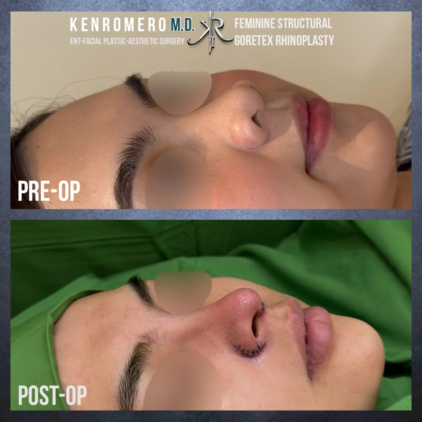 Feminine Structural Rhinoplasty: oblique, pre-op and post-op