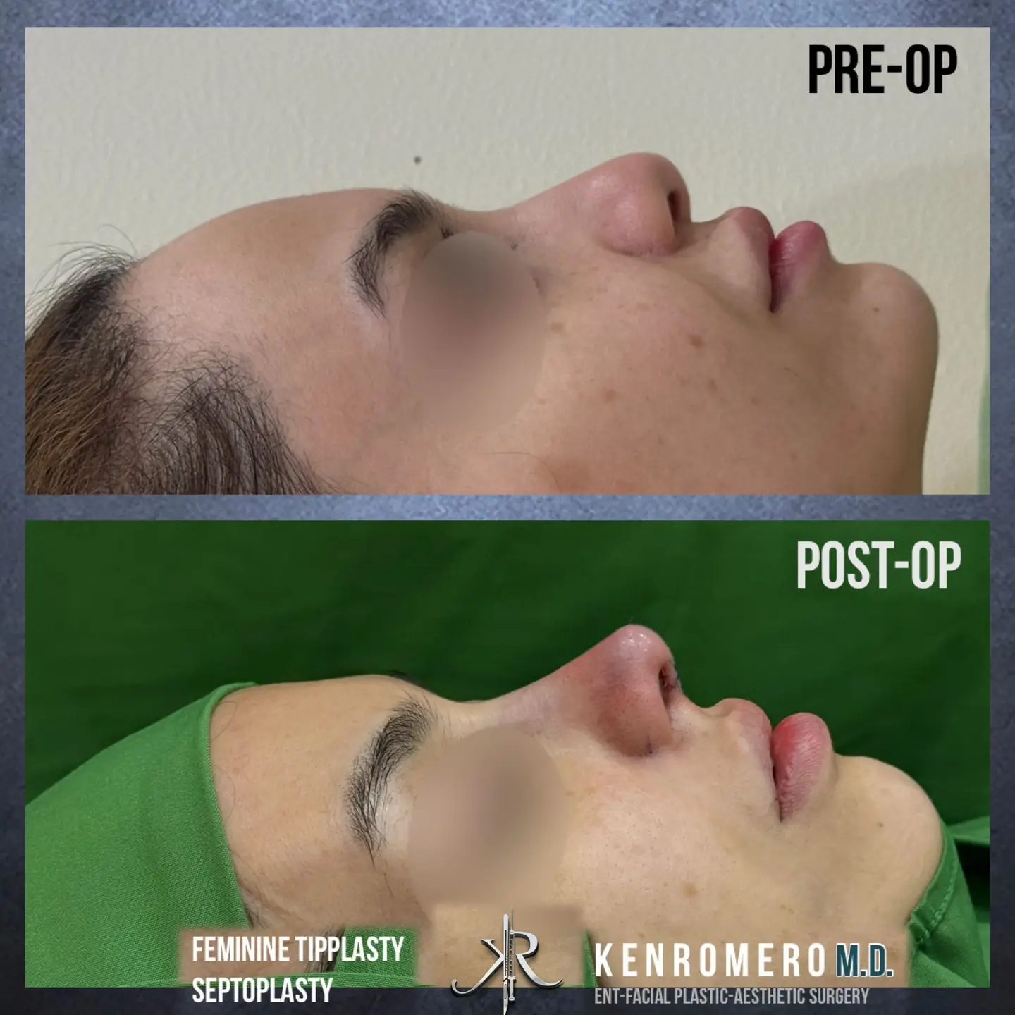 Feminine Tipplasty with Septoplasty: profile, pre-op and post-op