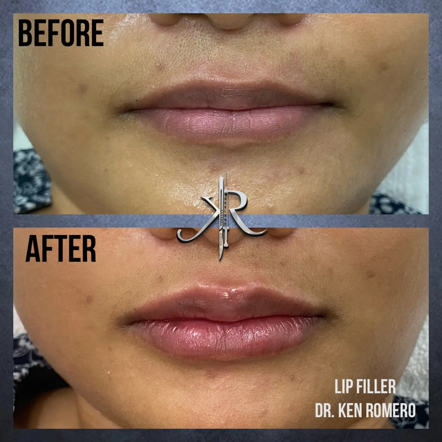 Lip Filler: front view, before and after
