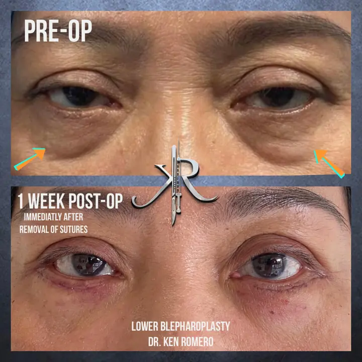 Lower Blepharoplasty: front view, 1 week post-op
