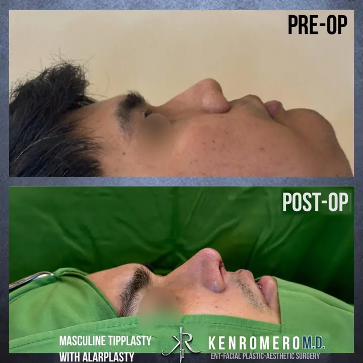 Masculine Tipplasty with Alarplasty: profile, pre-op and post-op