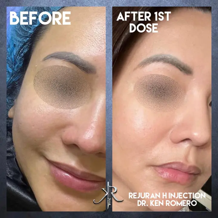 Skin Biostimulator: oblique, before and after 1st session