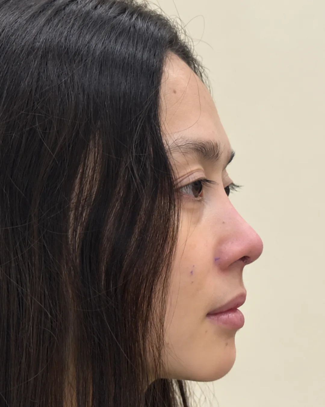 Profile, feminine rhinoplasty, after