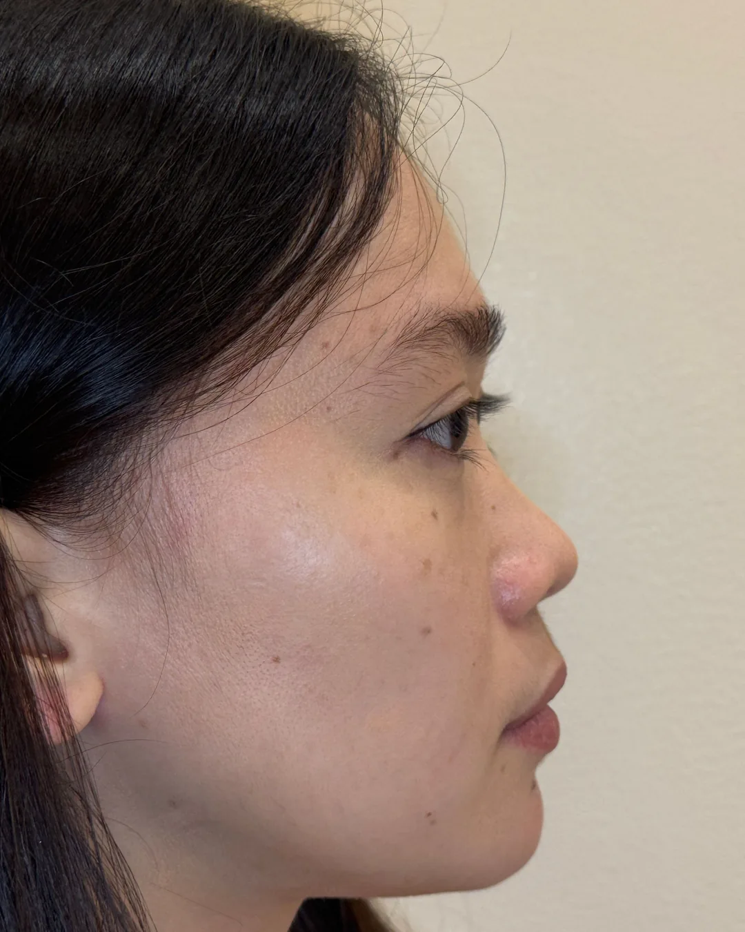 Profile, feminine rhinoplasty, before