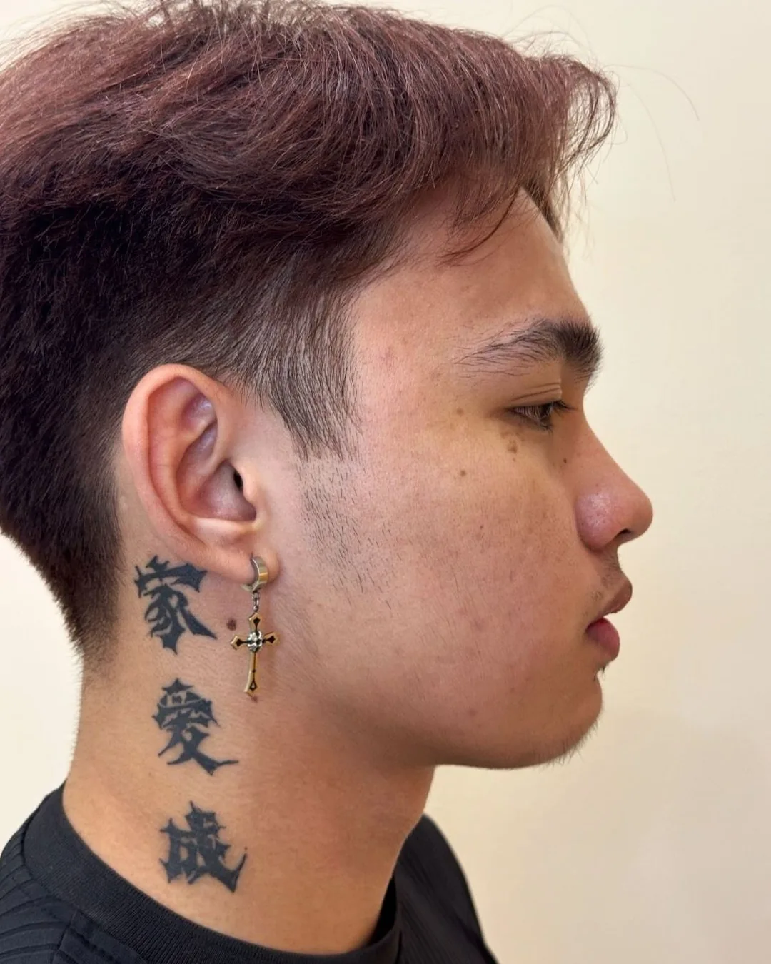 Profile, rhinoplasty with chin augmentation, before