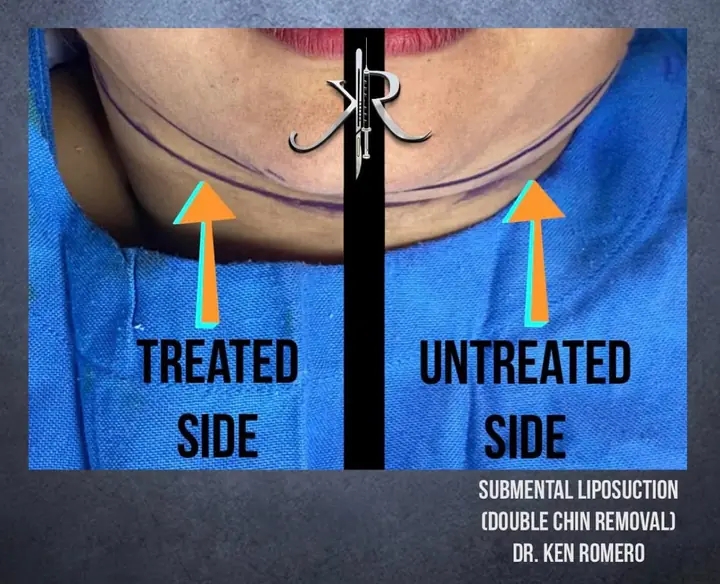 Submental Liposuction: under the chin, during surgery: treated vs untreated side