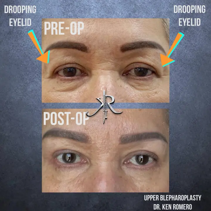 Upper Blepharoplasty: front view, pre-op and post-op